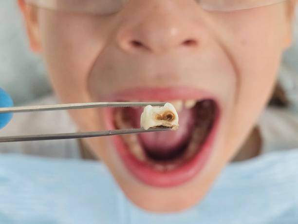 Best Emergency Treatment for Toothache in Lexington, OK