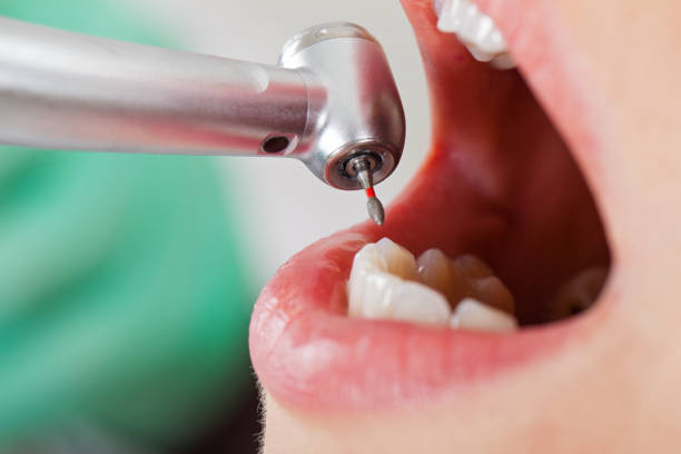 Best Emergency Root Canal Treatment in Lexington, OK